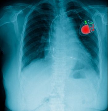 Radiografía del torso de un paciente con un marcapasos