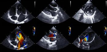 Imagen de ecocardiografía Doppler