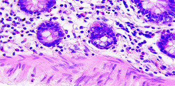 Imagen de microscopio de Células cancerígenas en la zona colorrectal