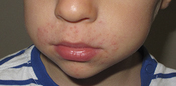 Boca de niño con dermatitis atópica