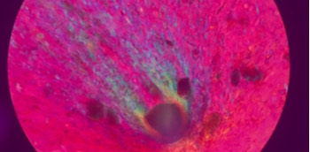 Imagen de microscopio que muestra hiperuricemia