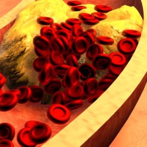 Glóbulos rojos creando riesgo cardiovascular