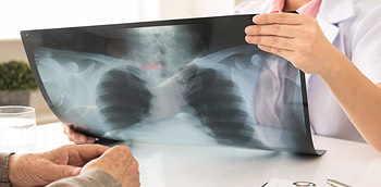 Radiografía de unos pulmones